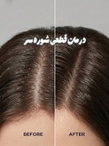 اسکراب کف سر لایتنس